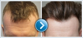 hair transplant clinic