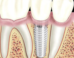 fogászati implantátum beültetése
